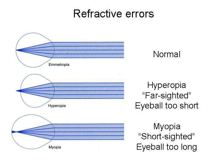 More refracting power is needed to focus on the retina; this can be provided by accommodation (slides 12-16), but is tiring over long periods and the decline in accommodation in age makes hyperopia