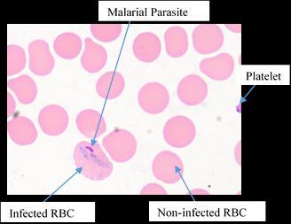 Fig. 3(a). Non-Malarial Blood Image. Fig. 3(b). Malarial Blood Image. 2.2 Red Blood Corpuscles (RBC) Extraction For the extraction of the RBCs, the image is performed with several operations.