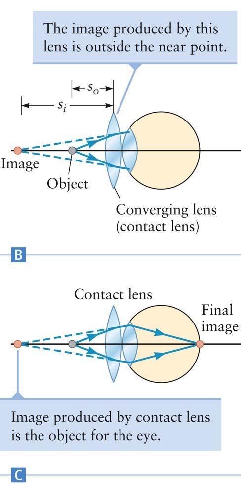 Far-Sighted Correction The contact (or glasses) lens is the first lens in the system For example, if a person s near-point distance is 75 cm, the corrective lens needs to