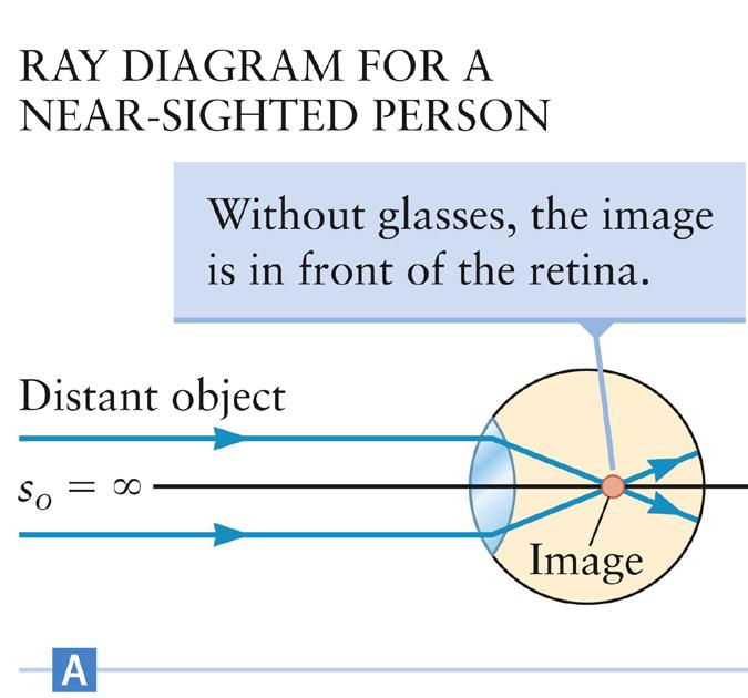 Near-Sighted Vision A nearsighted person is unable to focus light from distant objects on the retina The incoming rays from an object