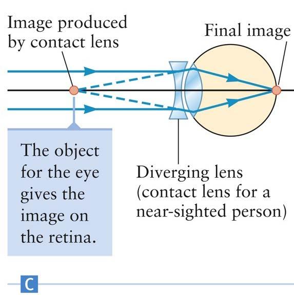 Near-Sighted Correction The object at needs to focus on the retina For example, if the person can