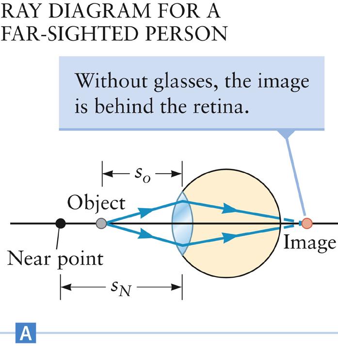 Far-Sighted Vision The near-point distance is greater than for a normal eye Objects located closer than