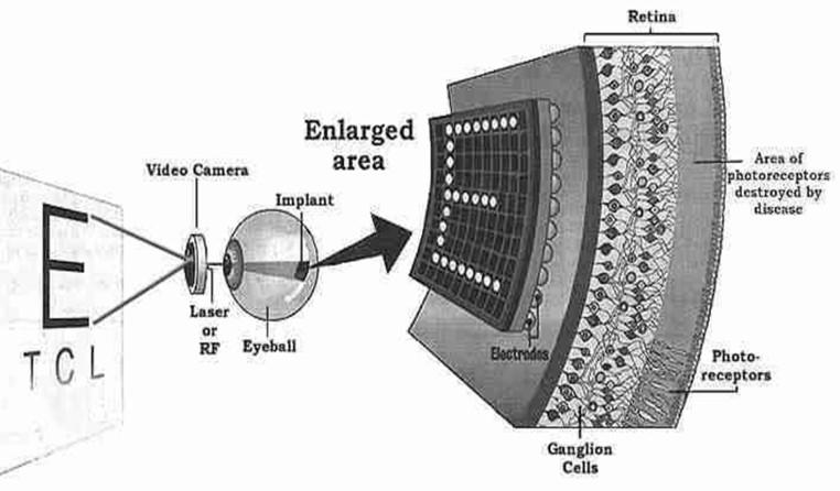 7 P a g e consists of a platinum or rubber silicon electrode array placed inside the eye to stimulate the cells.