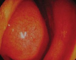 Colposcopy Tonsil