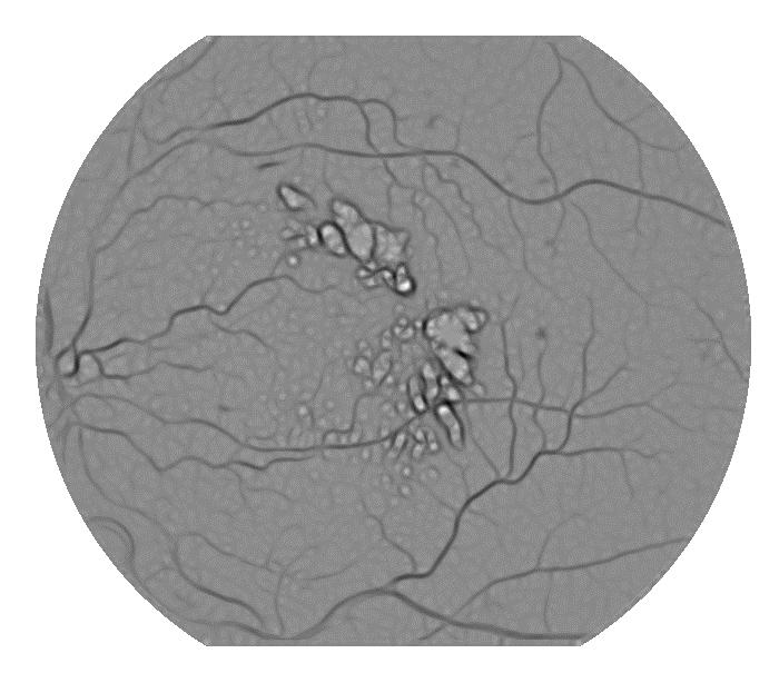 In [1], the cross section of a vessel in a retinal image was modeled by a Gaussian shaped curve, and then detected using rotated matched filters.