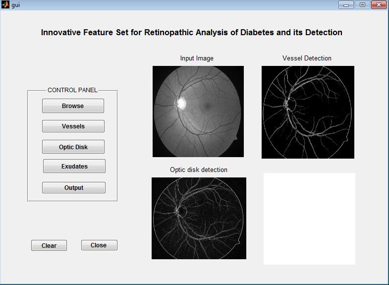Optic Disk Detection The blood vessel detection are major role in screening of eye diseases. Fig 8.