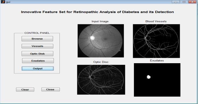 the image. Fig 9. Shows the Retinopathic analysis of diabetes and its detection. for optic disc and the blood vessels detections.