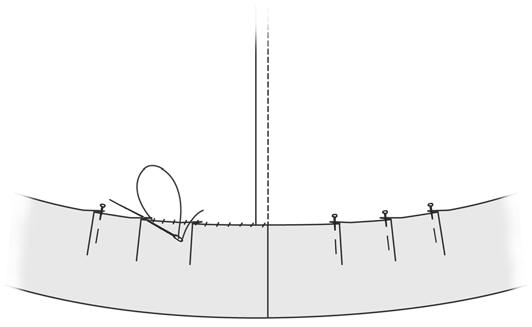 Turn under hem allowance and pin in place, making little tucks as necessary to draw in top folded edge of hem allowance to fit dress (fig. 27). Hem by hand.