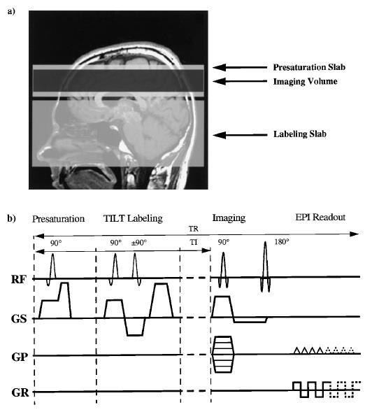 Pulsed ASL (PASL) Application of instantaneous RF pulse as labeling RF pulse typically 10-20 ms duration High tagging
