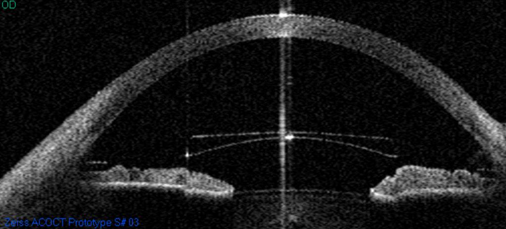 Arc-scanning with Artemis 2