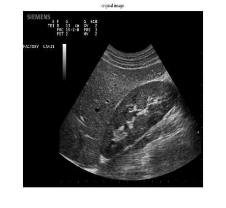 The figure explains the various steps involved in Denoising of ultrasound kidney image.
