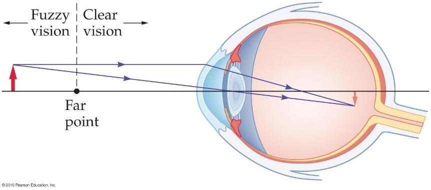 The Human Eye Myopia (nearsightedness) Even when fully relaxed, the lens is too curved (i.e. the light is bent too much).