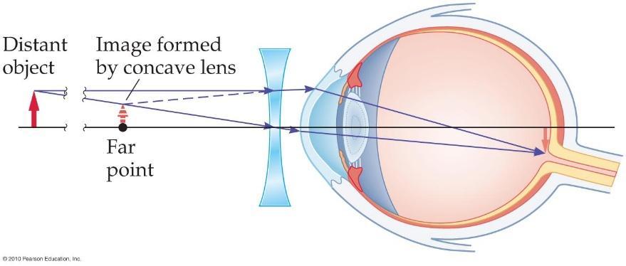 To correct, the light is intercepted by a diverging lens before it gets to the eye.