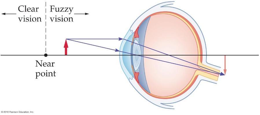 The Human Eye Hyperopia (farsightedness) The lens will not curve enough to focus on very close objects. If the object is too close, the image formed by the lens is behind the retina.