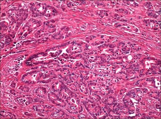Figura 2: Clasificarea WHO Carcinom Tubular Formele cu celule izolate şi caracter secretor, respectiv aspectul Mucinos şi cel de Inel cu pecete au fost întâlnite mai rar, în procente situate sub 15%