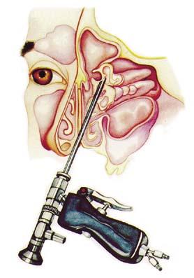 Applications Medical Endoscopic surgery ~ (micro) mechanical manipulation (is this