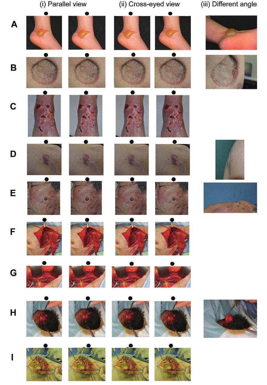 214 BioScience Trends. 2011; 5(5):211-216. Figure 2. (i) for parallel view, (ii) for cross-eyed view, (iii) picture from different angle to show the height/depth of lesion.