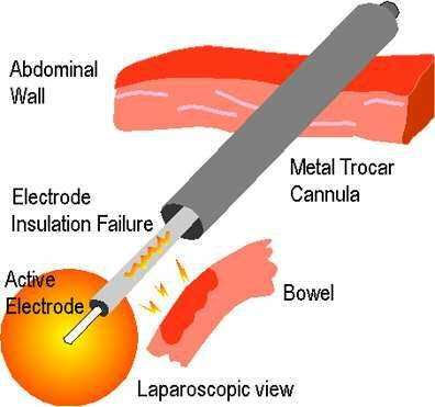 Hazardous practices to be aware of: > Buzzing the hemostat: touching the active electrode