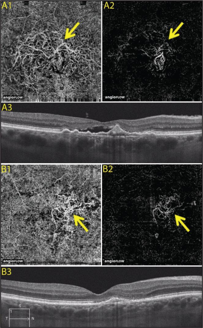 Supplement 197 Ophthalmic Tomography for Angiographic Imaging Storage SOP Classes Page 52 555 PED and incremental regression of the subretinal neovascular membrane by point to point registration OCT