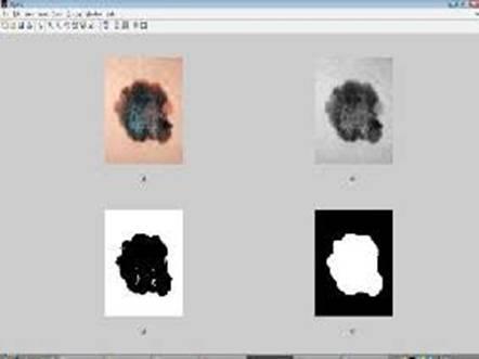 Using this method we analyze the tumour tissues in brain clearly and this lead to way for tumour treatment. MATLAB is a tool for processing the image of both normal brain image and tumour brain image.