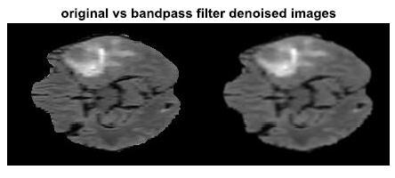 From the table, it is quite evident to choose the lowpass filter as an optimal filter for removing the noise present in the MRI images both in respect of the PSNR and the MSE. S.