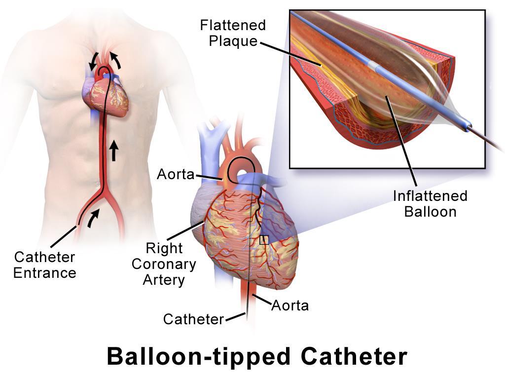 Getting There To put it in perspective, the image on the right shows the route a surgeon must navigate to deliver and inflate a balloon for an angioplasty procedure.