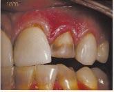 cases: tipveneer Shoot the shade guide at the incisal edge of the prepared tooth