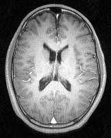 myelin, are visible, as is the falx cerebri (long, thin arrows).