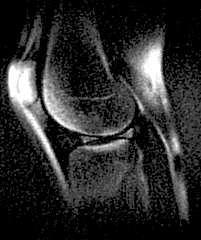 The menisci and patellar tendon are particularly visible in (b), (c), and