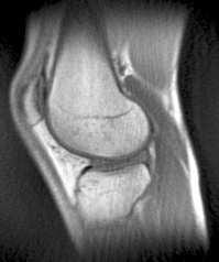 (d) also shows the iliotibial band and the anterior cruciate ligament