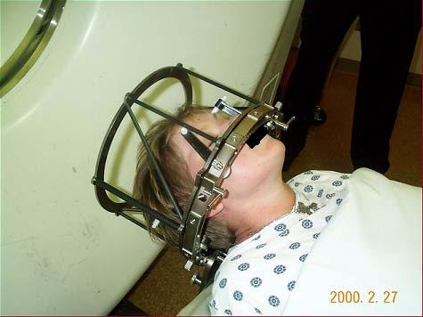 attaching an invasive head ring to the patient to which a stereotactic localizer attaches for computed tomography (CT) imaging.