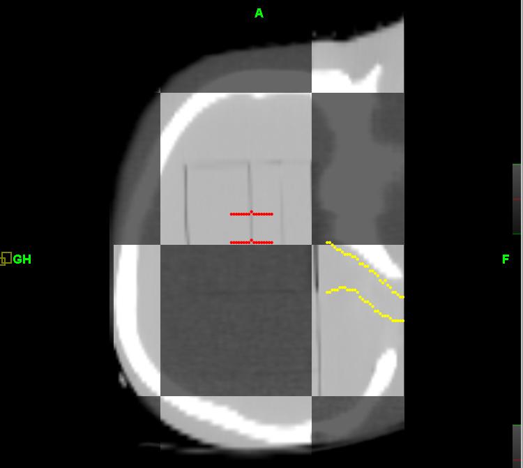 2.3.3 Phantom Dose Delivery Once the appropriate offsets were applied, a volume of slices covering the full phantom was selected, and a fine (2 mm slice thickness) MVCT was acquired.
