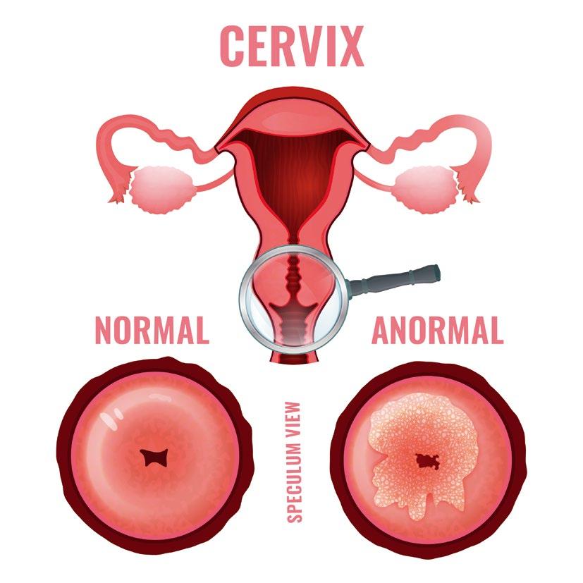 16 PREVENIREA CANCERULUI DE COL UTERIN Cancerul de col uterin poate fi prevenit! Este mai ușor să previi decât să tratezi.