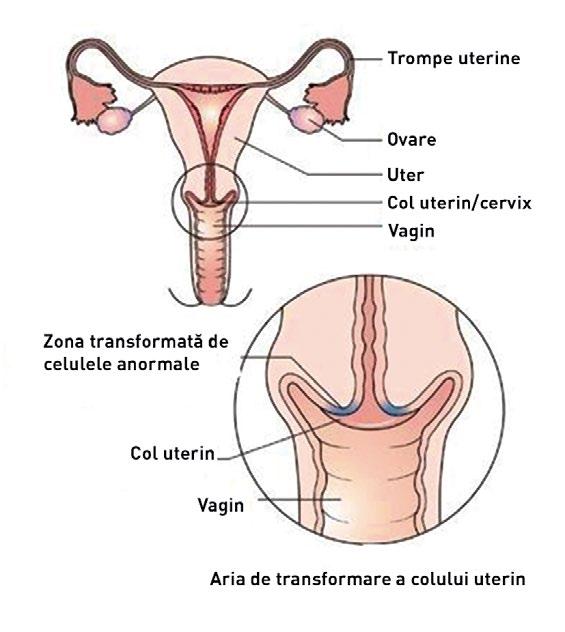 Babeș-Papanicolau. Dacă este depistat devreme, cancerul de col uterin poate fi depășit. Acesta este unul dintre cancerele cu cea mai mare rată de succes a tratamentului.