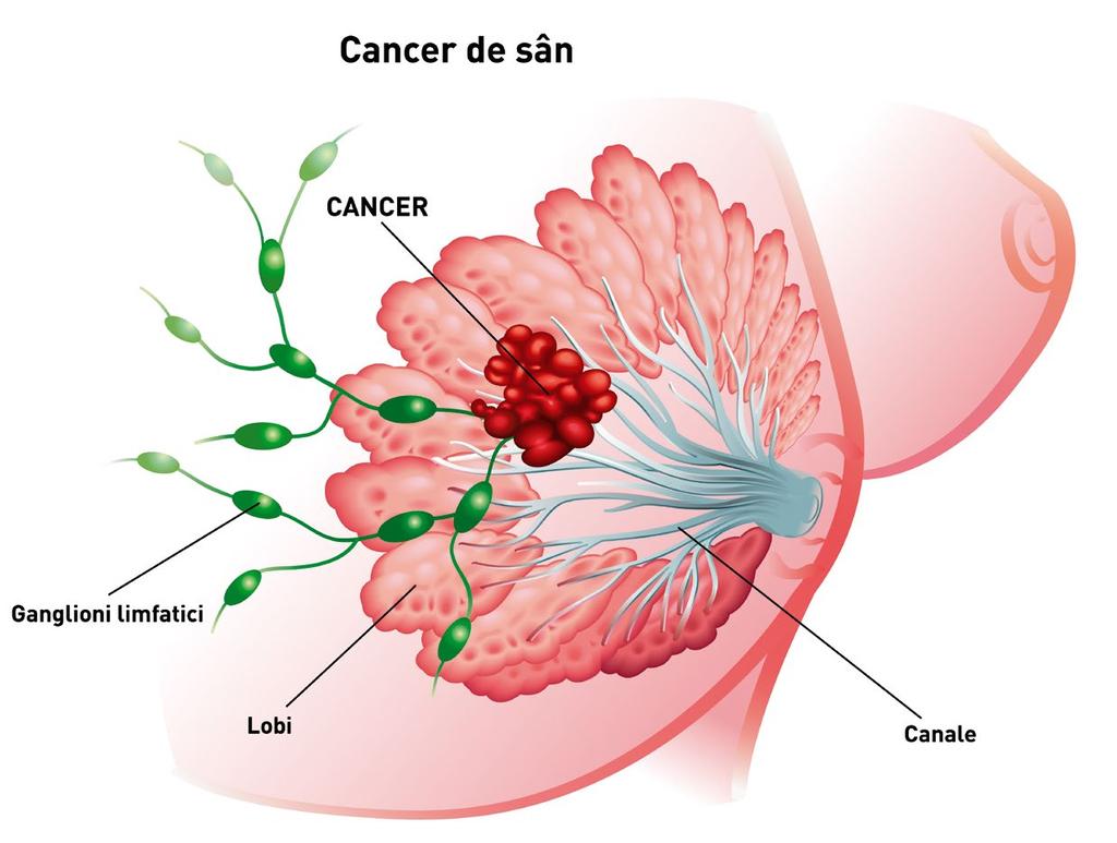 PREVENIREA CANCERULUI DE SÂN Cancerul de sân poate fi prevenit! Este mai ușor să previi decât să tratezi.