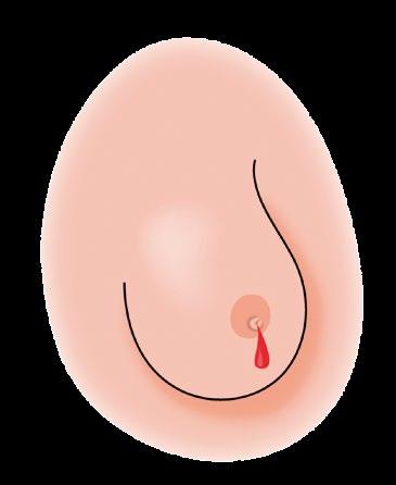Desen vascular vizibil (vene îngroșate) Modificare de consistență (întărire) a unuia dintre sâni sau chiar localizată Modificarea formei sau mărimii sânilor, asimetrie a sânilor sau modificare