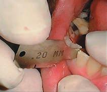 (3) Aid in the establishment of parallel proximal walls during enamel reduction.