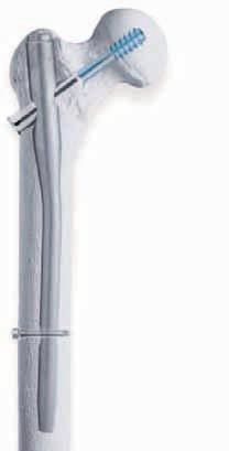 Indications The Biomet Peritrochanteric Nail System is indicated for the treatment of fractures of the femur including: Intertrochanteric fractures Combination