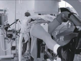 Surgical Technique 1. Patient Positioning The patient is positioned supine on a fracture table with the affected leg in a neutral position or slightly adducted.