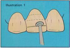 PORCELAIN VENEER PROCEDURE PLEASE NOTE: The following instructions are a guide to tooth preparation when a full compliment of