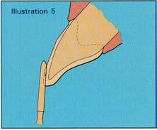 The shank is held parallel with the tooth to create a depth cut guide for preparations. See Illustrations 1 & 2.