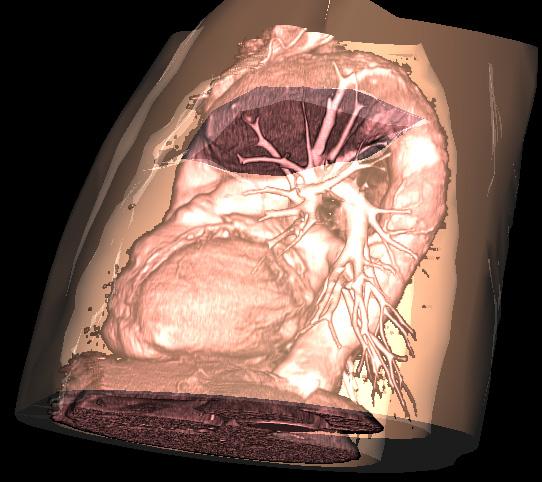 simulation, especially for the simulation of ablation. 2007.