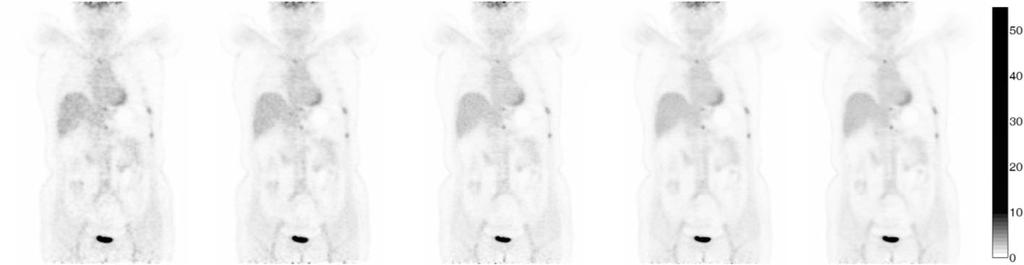 Huo et al. EJNMMI Physics (2018) 5:29 Page 11 of 17 A B C D E Fig. 4 Coronal slices of clinical PET whole-body images acquired with the PoleStar m660 PET/CT.