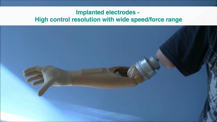 Bionic Limbs: