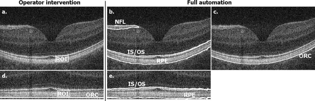 Fig. 5 Illustration of the procedure of segmentation of the posterior retinal layers including RPE and IS/OS junction.