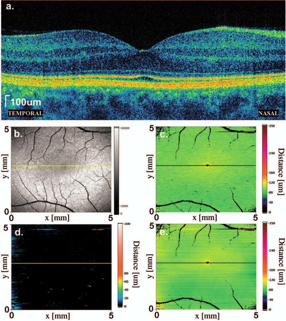 Szkulmowski et al.: Analysis of posterior retinal layers Fig. 9 Analysis of SOCT data for the macular region of a normal 共right兲 eye.