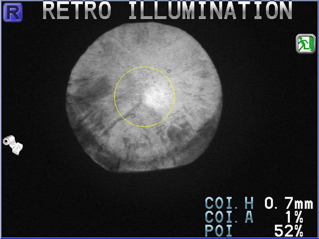 1-3. Retro-illumination Image The shadow on lenticular can be observed like retinoscopy. Opacity indication helps to predict the progression of Cataract.