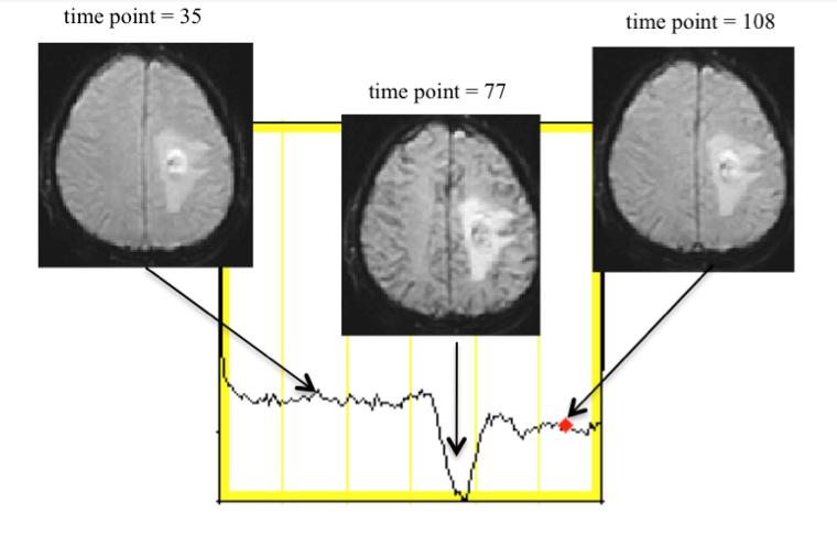 Dynamic Susceptibility Contrast (DSC)- MRI Protocol Description The DSC-MRI protocol consists of administering a preload of a Gd (the Gd used for the DCE exam), followed by the collection of echo