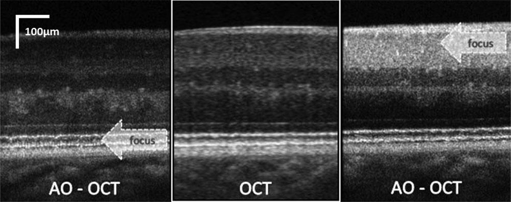 It is evident that increased NA (pupil) diameter reduced the average speckle size and additionally that the AO ensured improved resolution and intensity of the retinal layers in focus by correcting