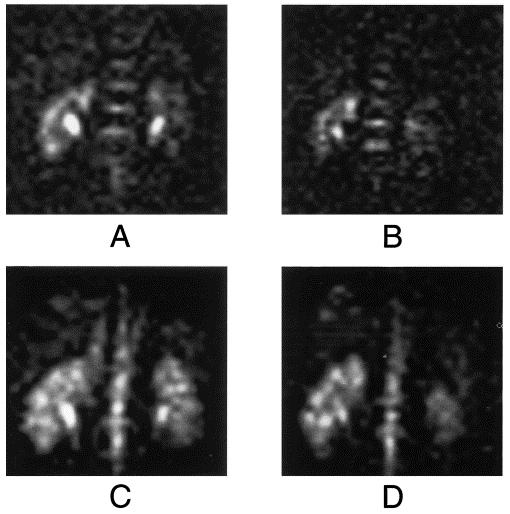 Figure: Sodium Coronal images of the kidneys of a 37-year-old male. A,C Kidneys in a dehydrated state after 12 h without drinking.